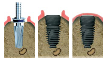 Implant dentaire à Villepinte